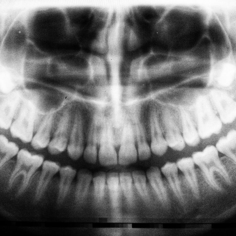 A digital radiograph of a full mounth of teeth
