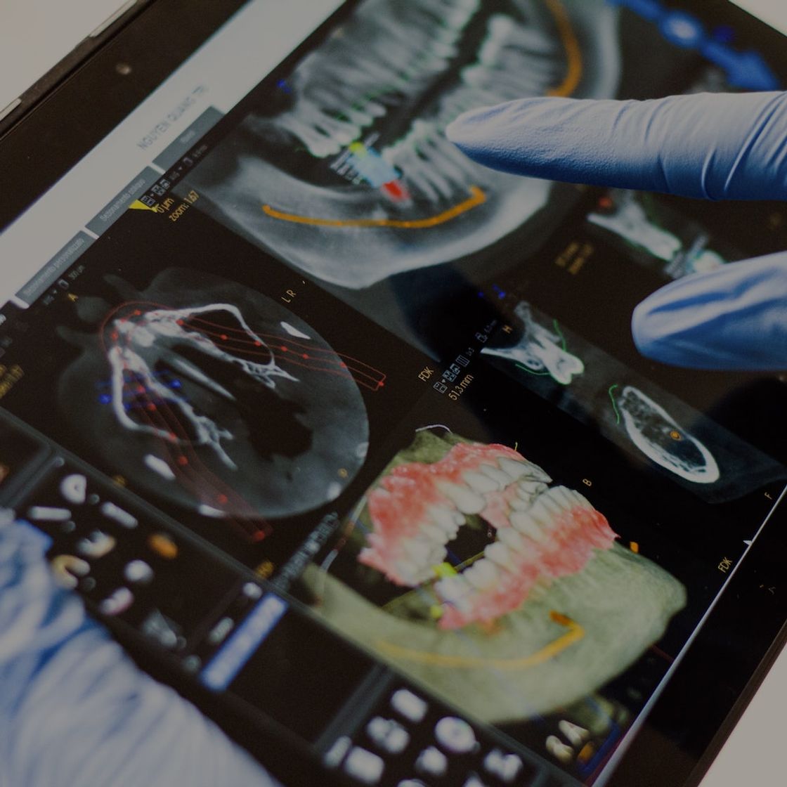 A close up a medical imaging screen showing a 3D image of mouth and teeth